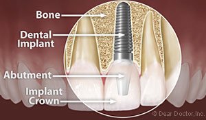 dental implant, Dentist Morrisville