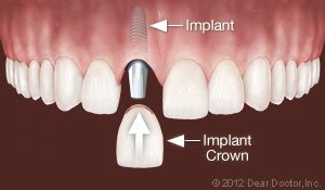 Dentist Morrisville dental implants